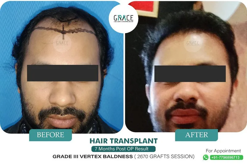 Before and after hair transplant result