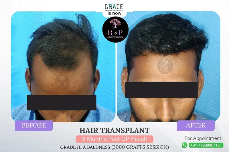 Grade III baldness before and after result