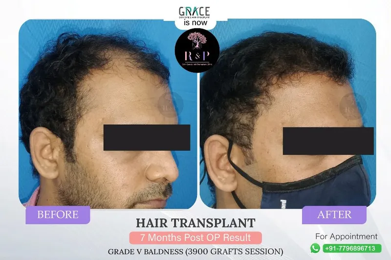 Grade V baldness result